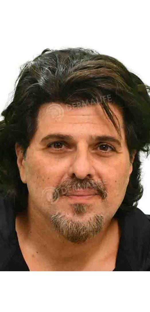 Bhakhtyar Irani — after hair transplant at Dermalife