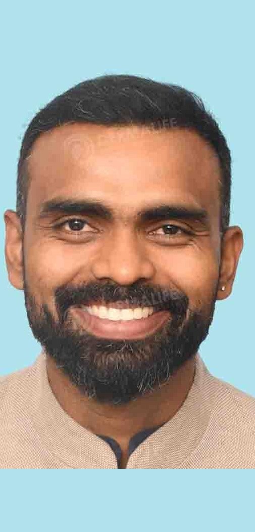 PR Sreejesh — after hair transplant at Dermalife