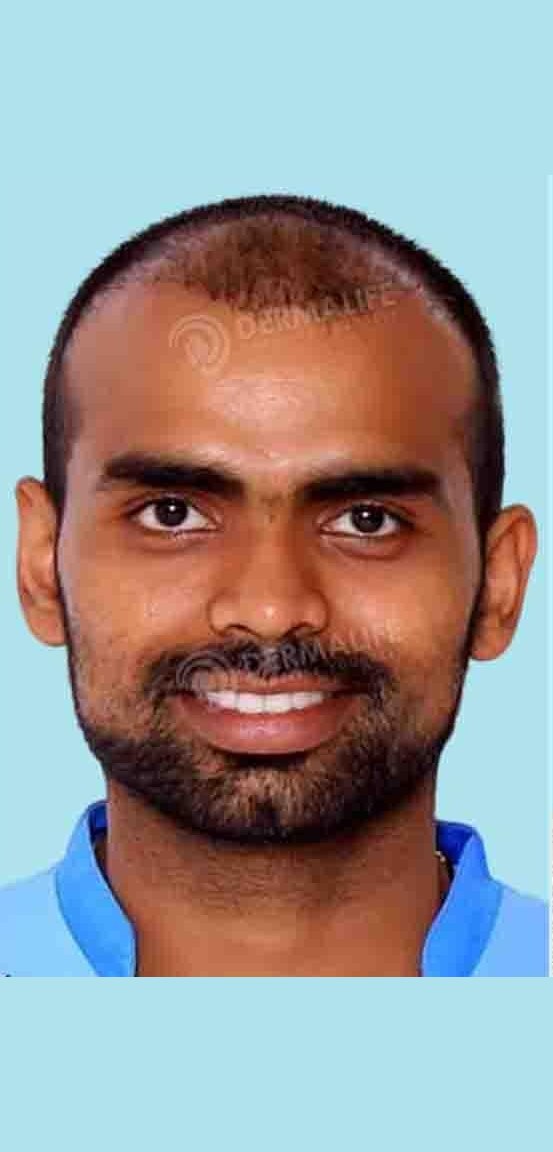PR Sreejesh — before hair transplant