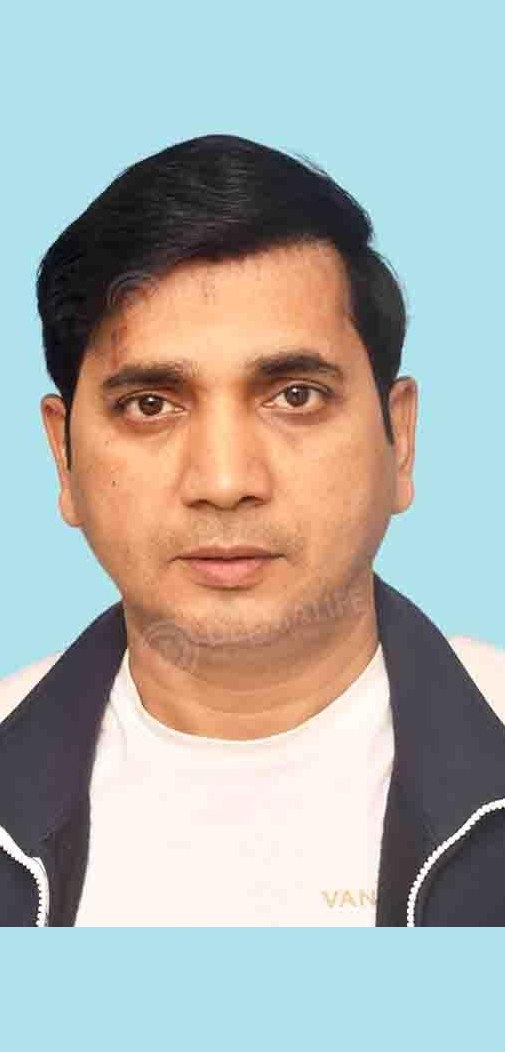 Saanand Verma — after hair transplant at Dermalife