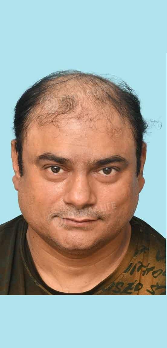 Saleem Zaidi — before hair transplant