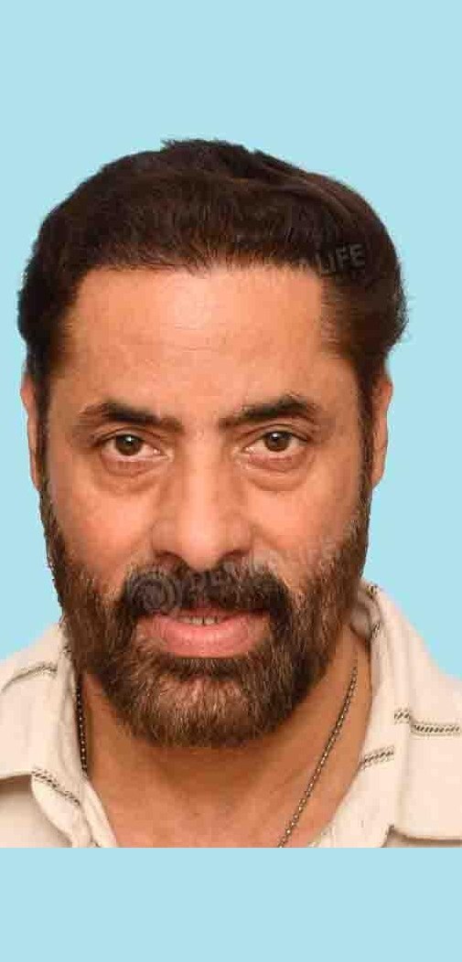 Shaji Choudhary — after hair transplant at Dermalife