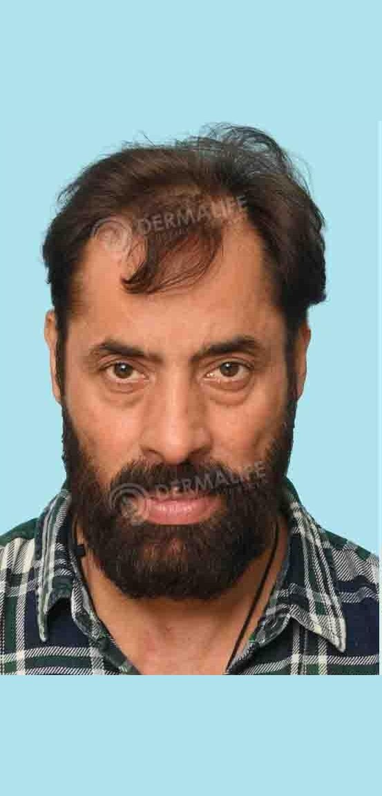 Shaji Choudhary — before hair transplant