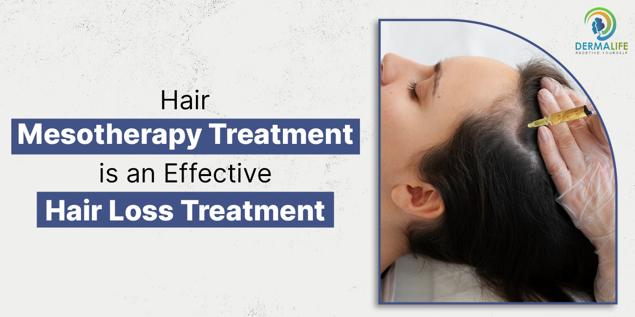 Hair Mesotherapy Treatment is a Effective Hair Loss Treatment