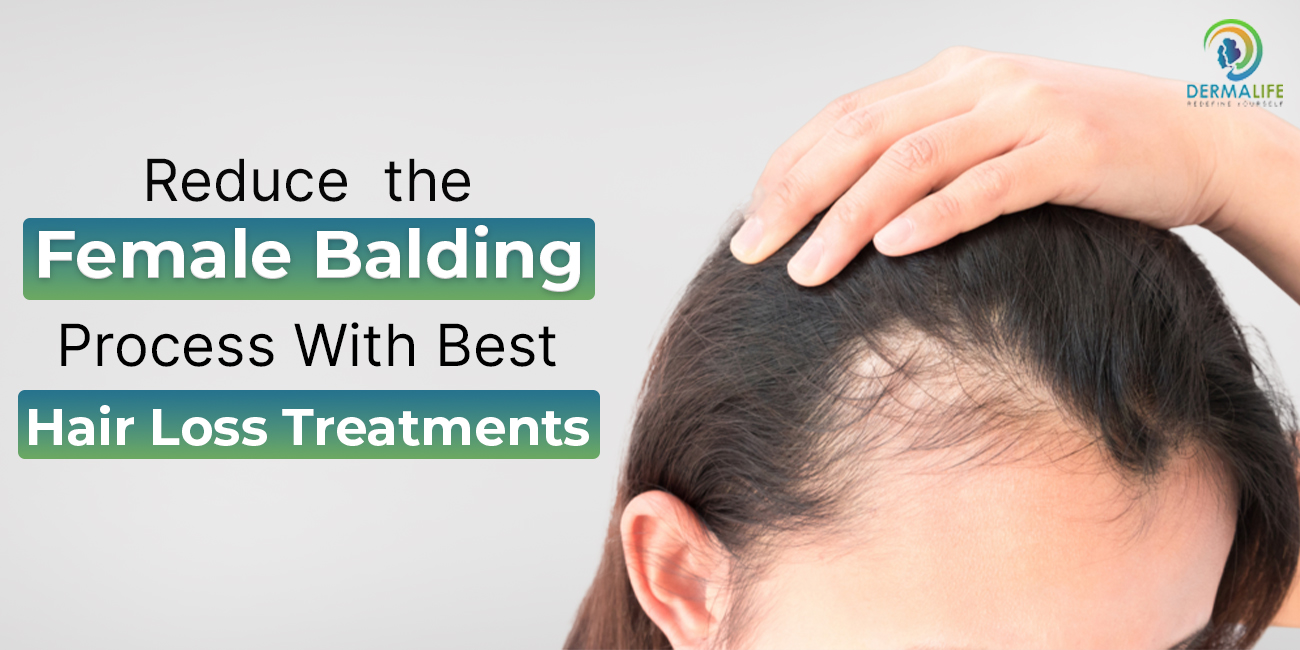 Reduce the Female Balding Process With Best Hair Loss Treatments