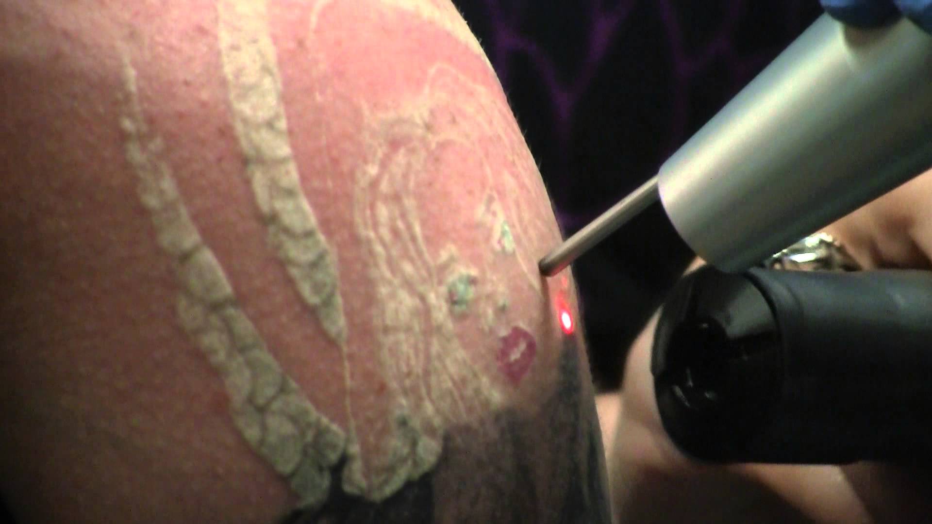 Laser Tattoo Removal - How Painful is it and What's the procedure? |  Dermalife Blog