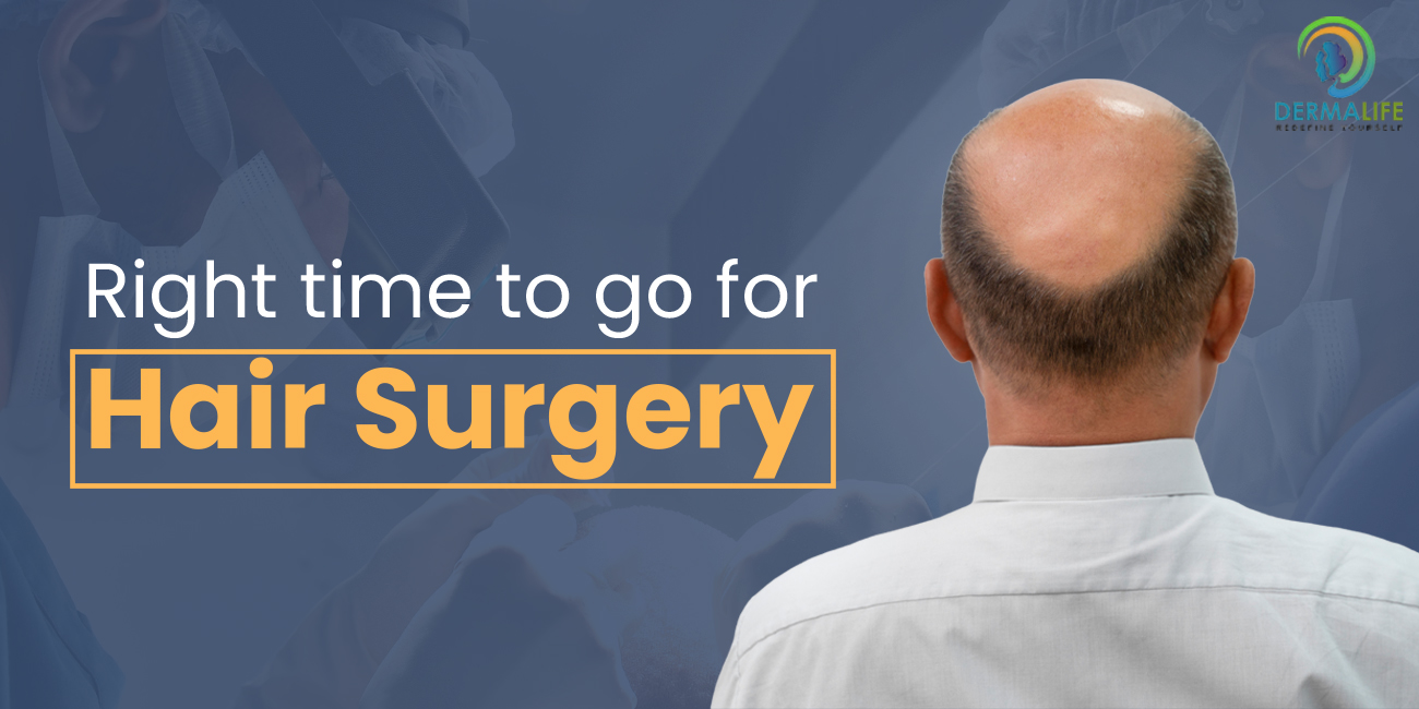 Right Time To Go for Hair Surgery