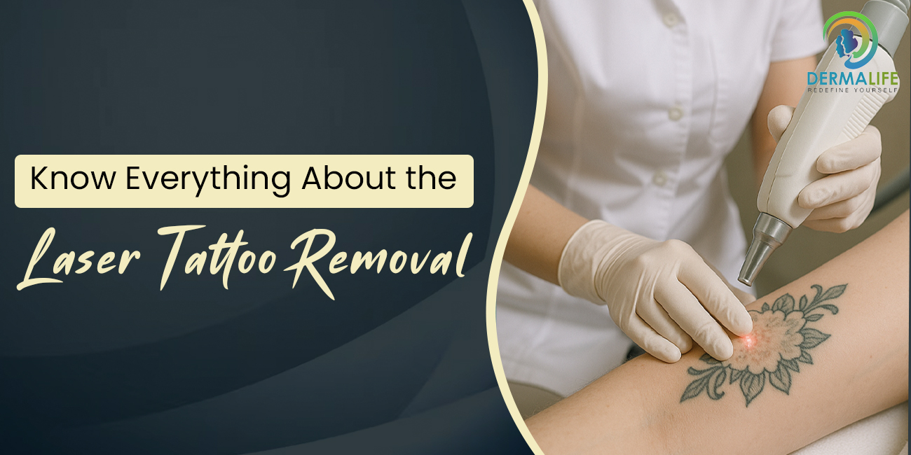 Everything About the Laser Tattoo Removal