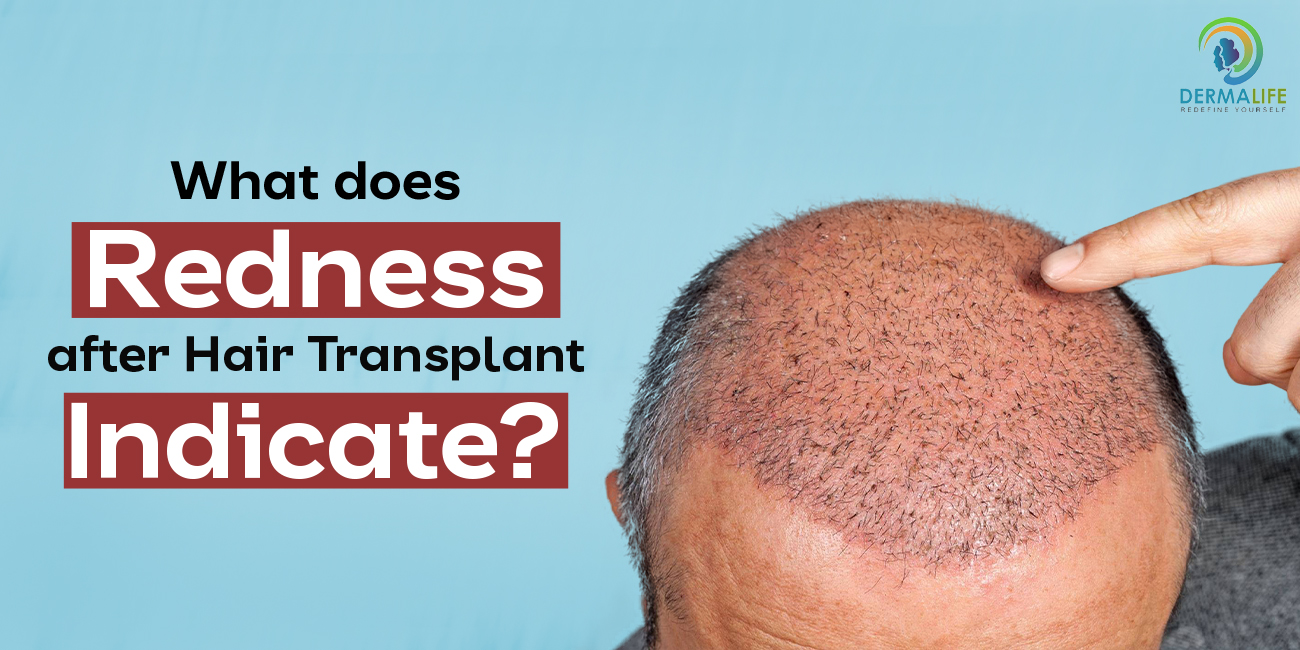 What does redness after hair transplant indicate