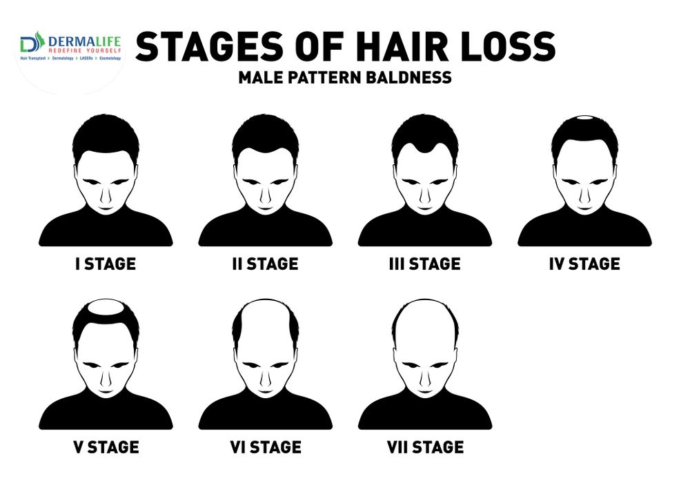 stage of male baldness