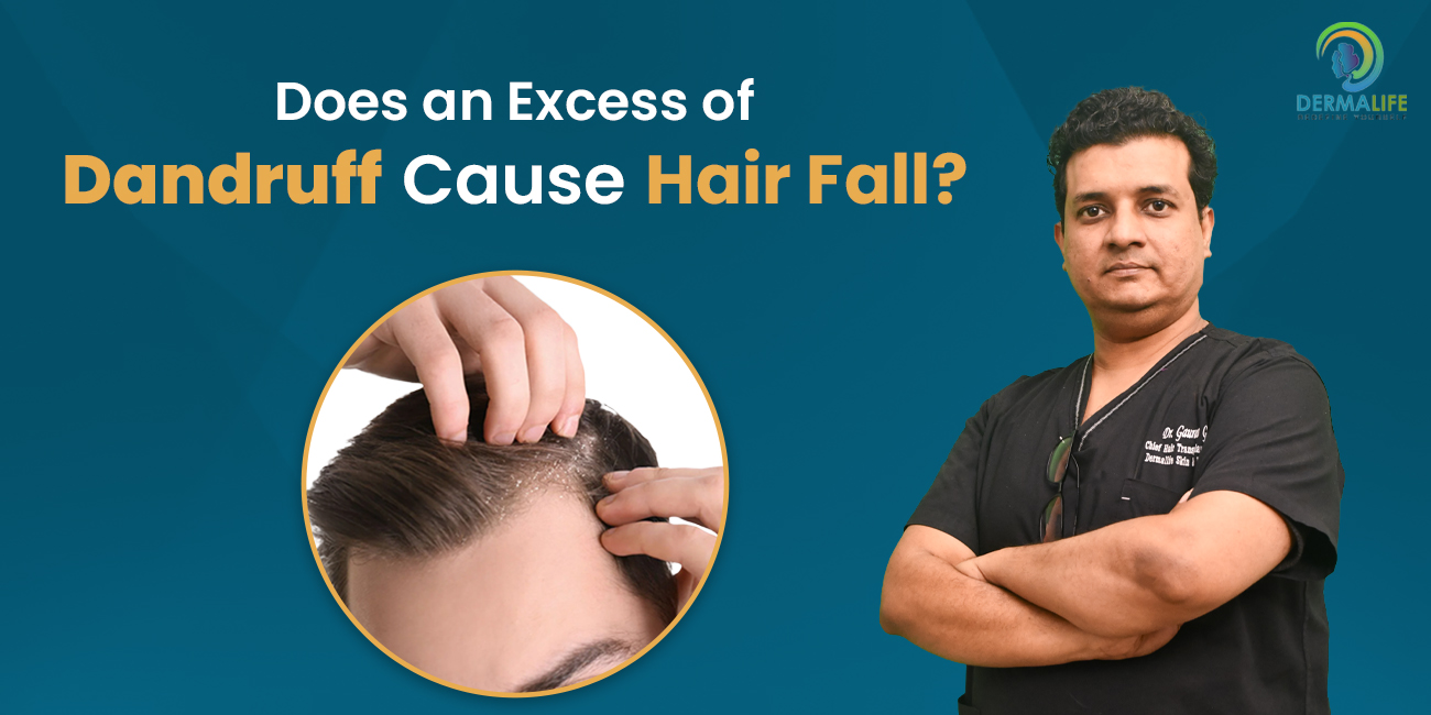 Does Excess of Dandruff cause Hair Fall
