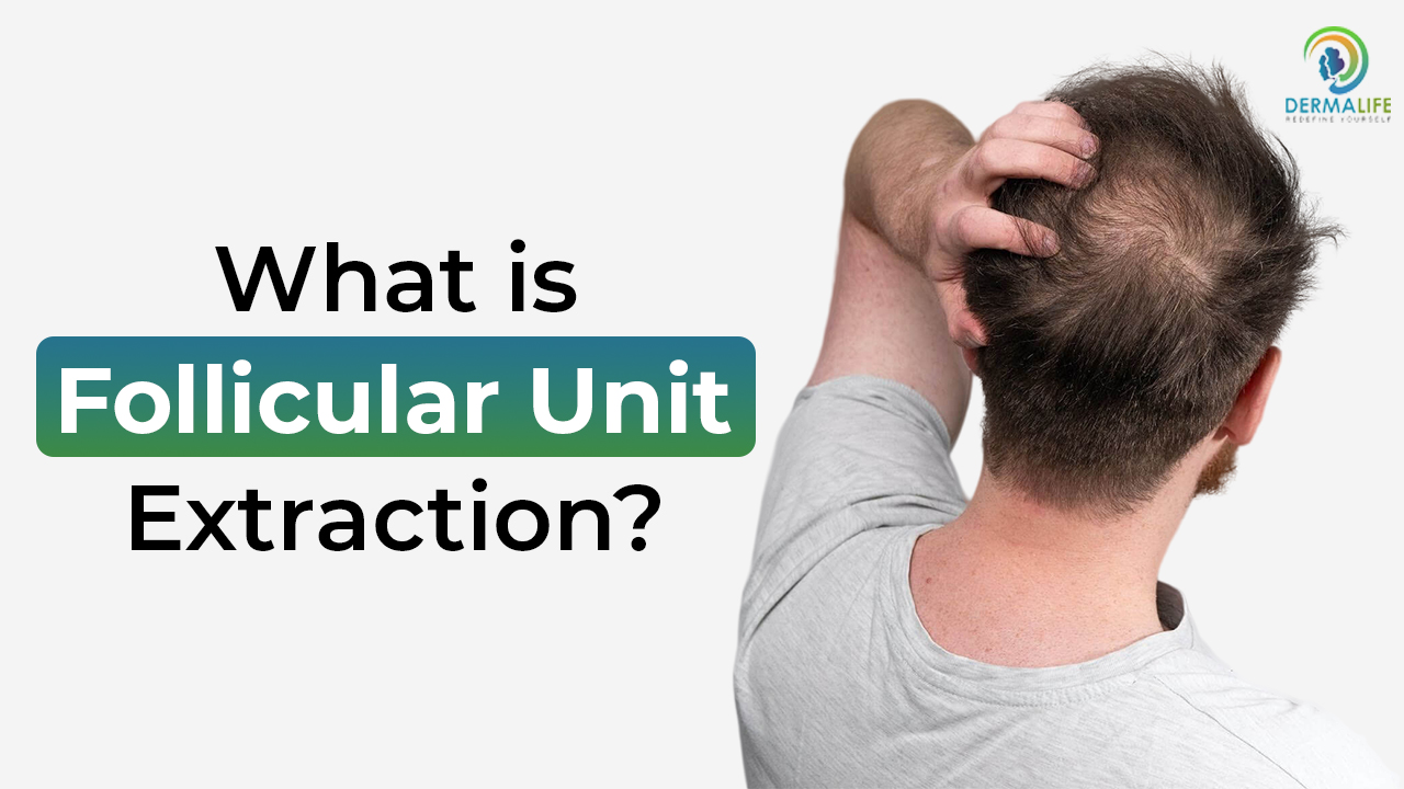 What is Follicular Unit Extraction