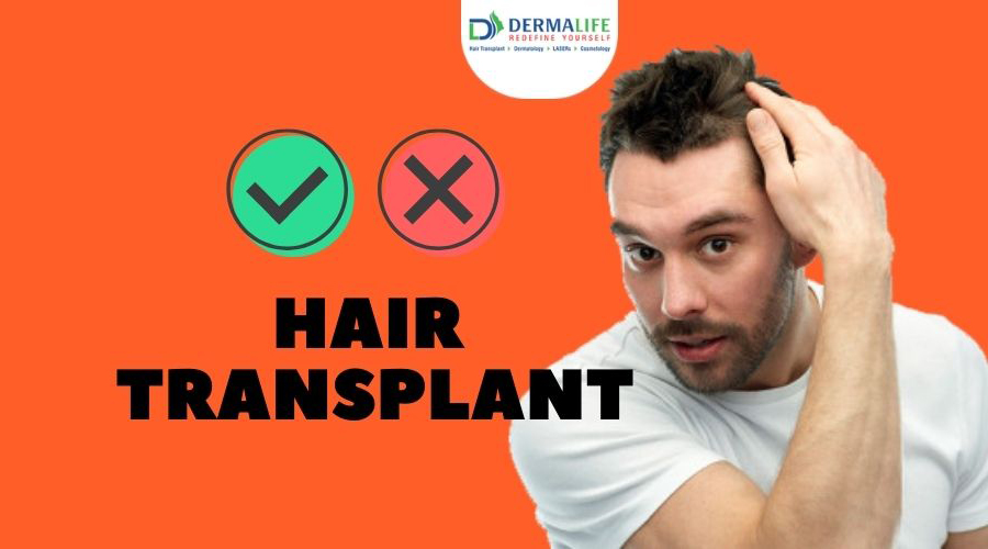 Do’s and Dont’s after hair transplant