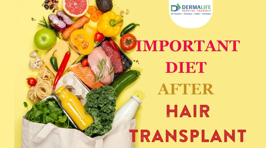 What to eat After Hair Transplant