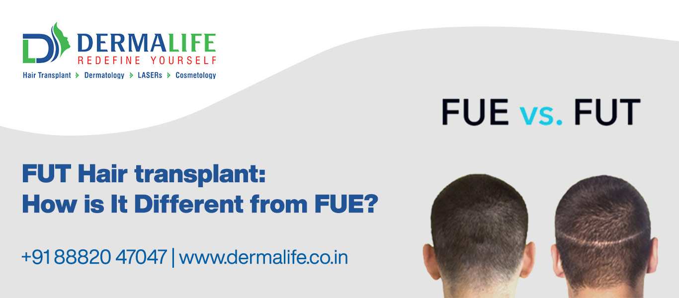 FUT Hair Transplant Procedure: Benefits, Side effects | Dermalife