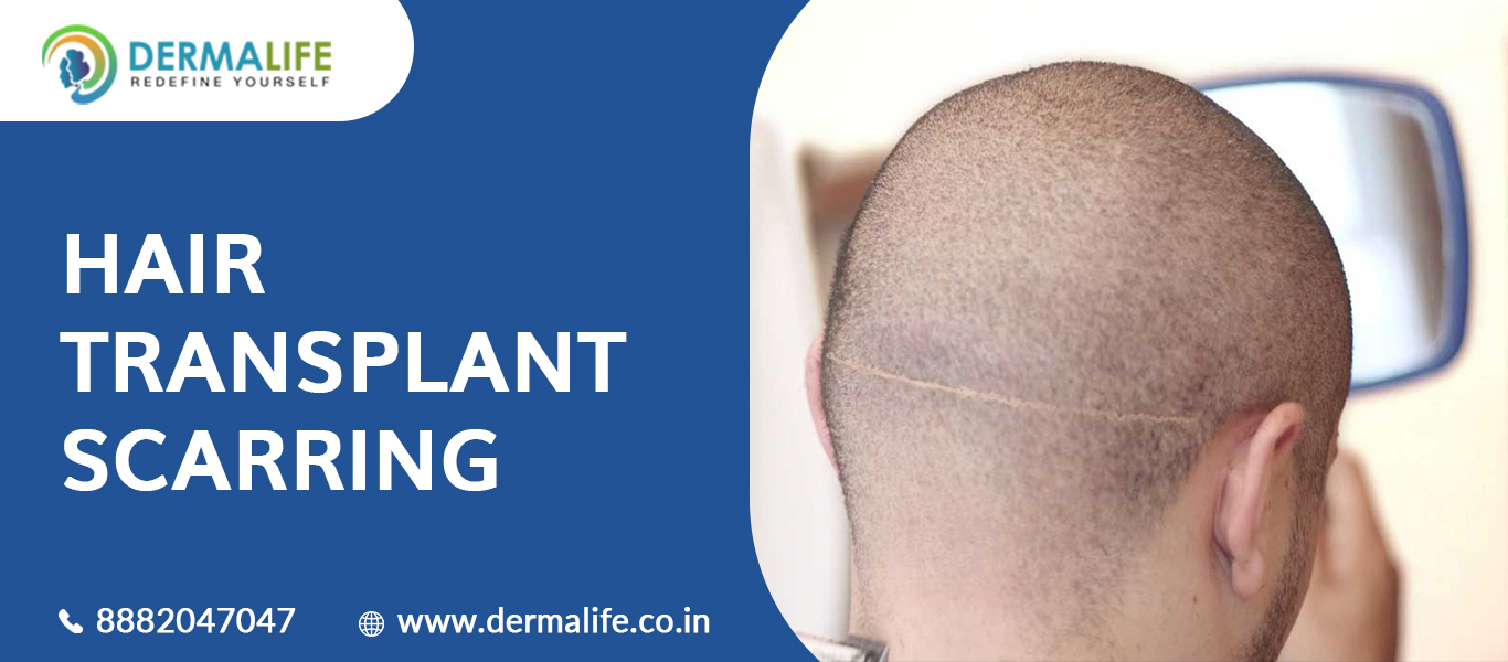 Hair Transplant Scar | FUE Hair Transplant Scars | Follicular Unit  Extraction Scarring - Dermalife