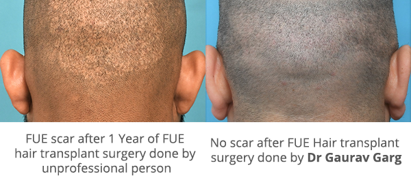 FUE Scars After 1 Year of Hair Transplant