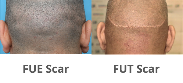 FUE and FUT Scars