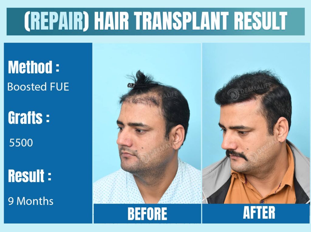 repair hair transplant in India