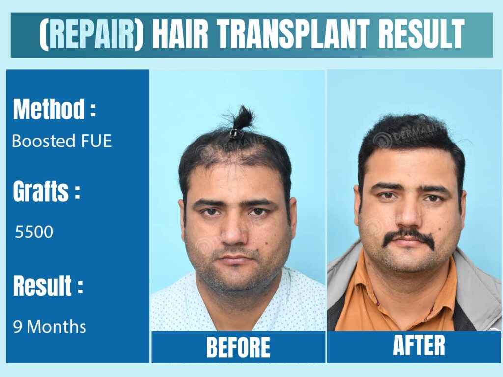 repair hair transplant in India