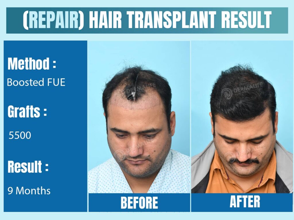 repair hair transplant in India