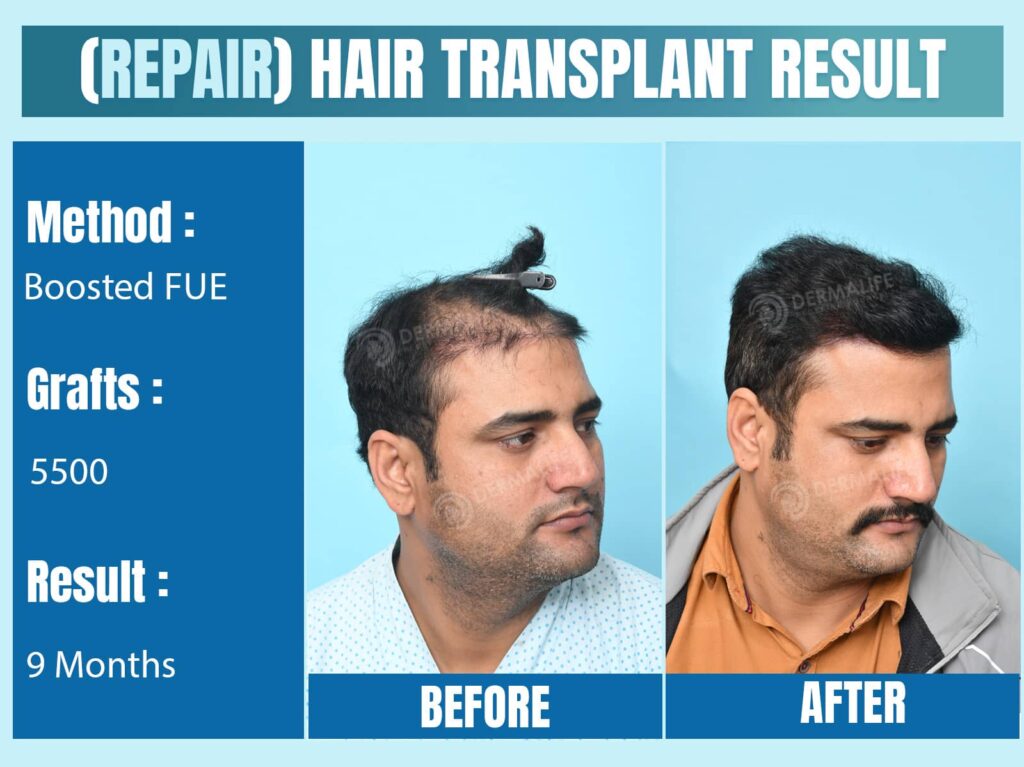 repair hair transplant in India