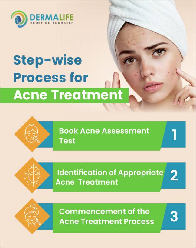 acne treatment