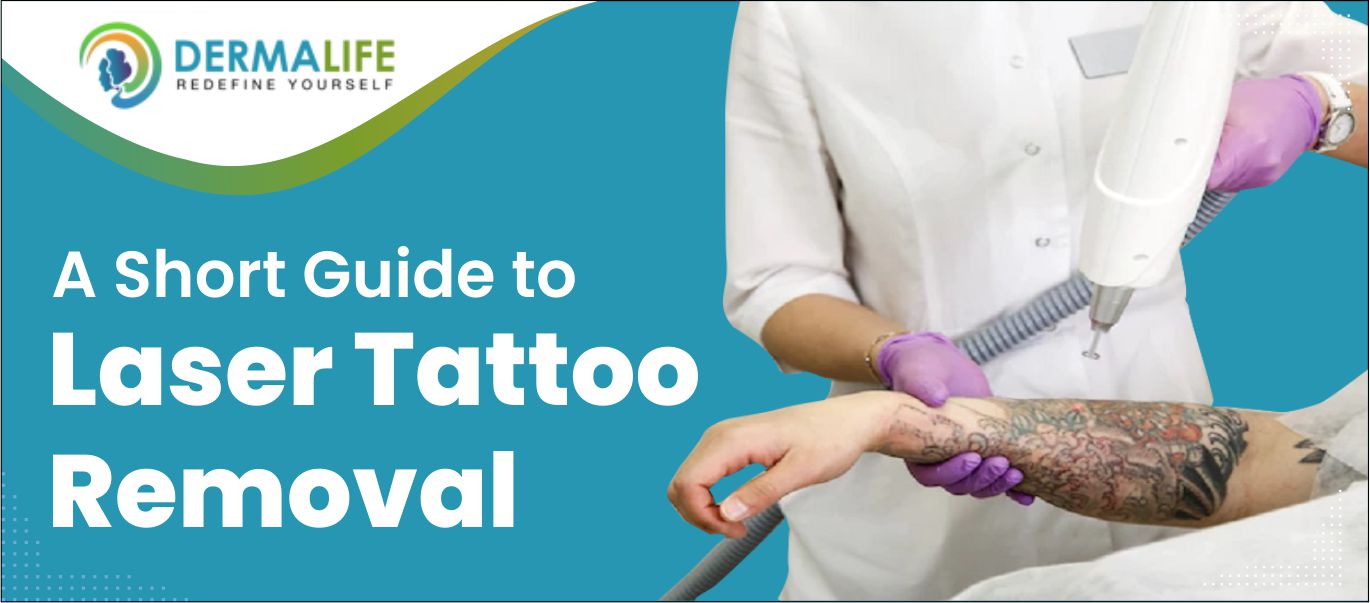 Laser Tattoo Removal