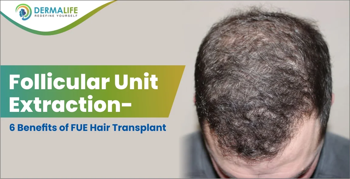 Follicular Unit Extraction- 6 Benefits of FUE Hair Transplant