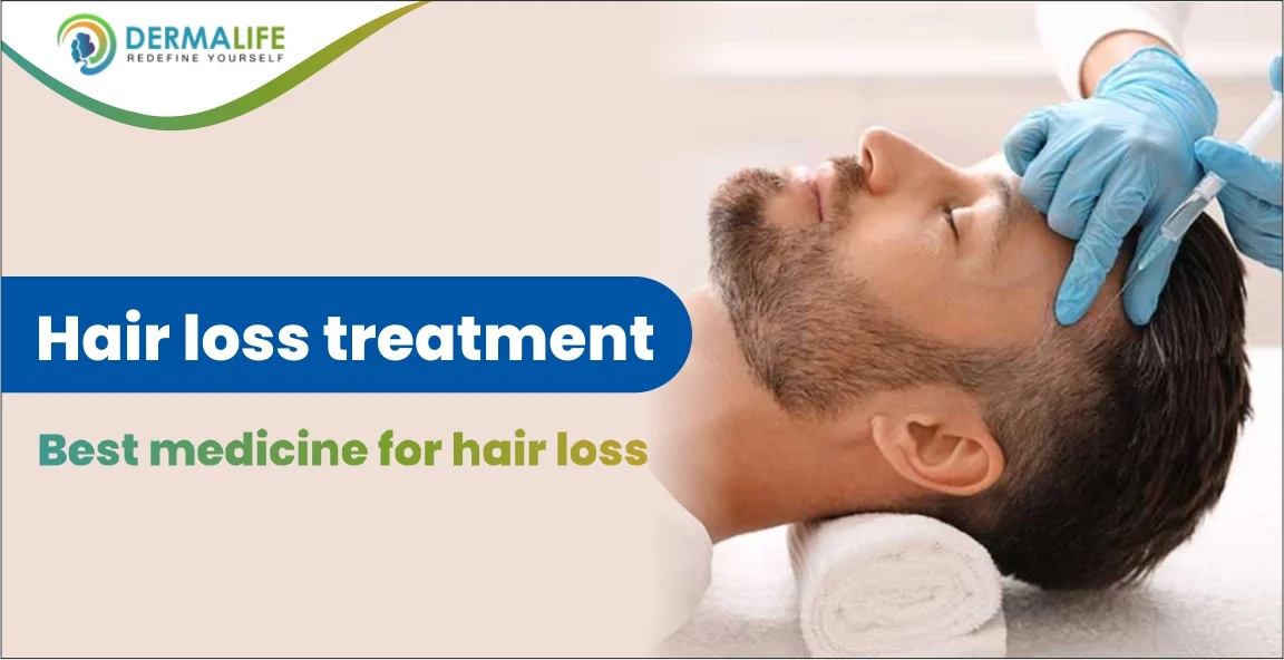 hair loss treatment- best medicine for hair loss