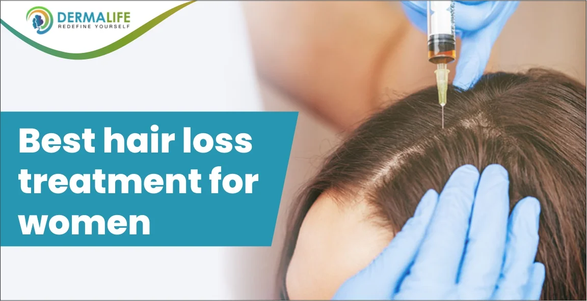 Best hair loss treatment for women