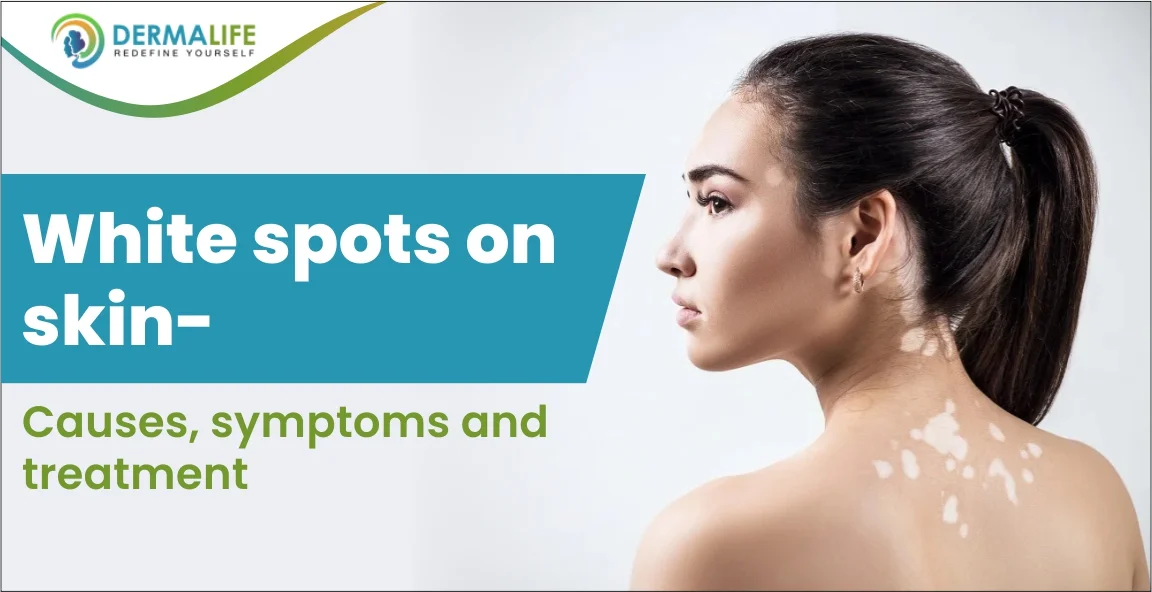 white spots on skin- Causes, symptoms & treatment
