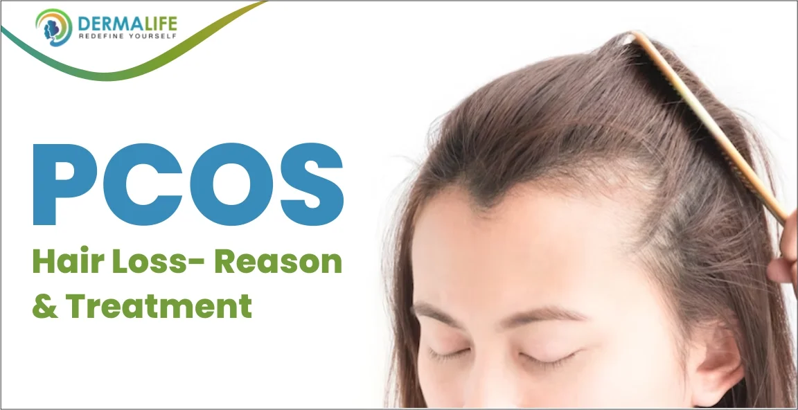 PCOS hair loss