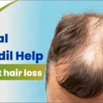 Can oral Minoxidil Help treat hair loss?