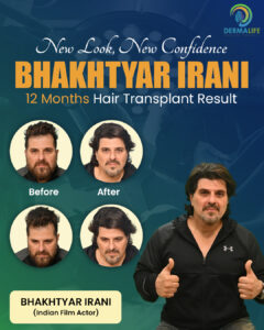 Bhaktiyar Irani Hair Transplant