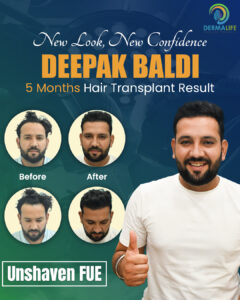 Deepak Baldi Unshaven FUE