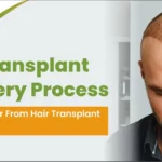 hair transplant recovery process