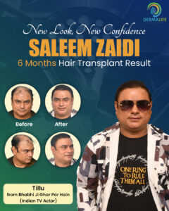 Saleem Zaidi Hair Transplant