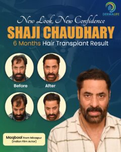 Shaji Chaudhary Hair Transplant