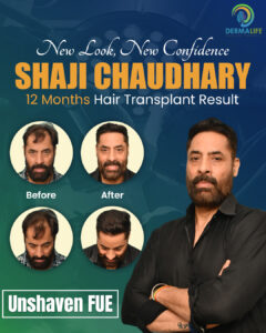 Shaji chaudhary Unshaven FUE