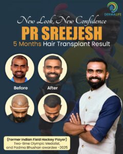 Sreejesh PR Hair Transplant