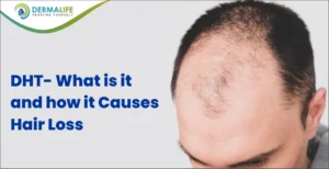 DHT- What is it and how it causes hair loss
