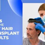  9 Tips for The Best Hair Transplant Results
