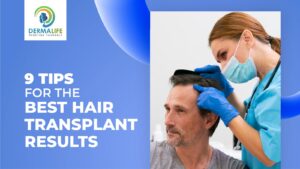  9 Tips for The Best Hair Transplant Results