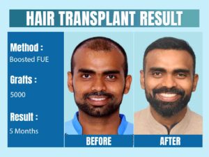Celebrity Hair Transplant in India