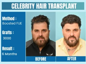 Celebrity Hair Transplant Before After