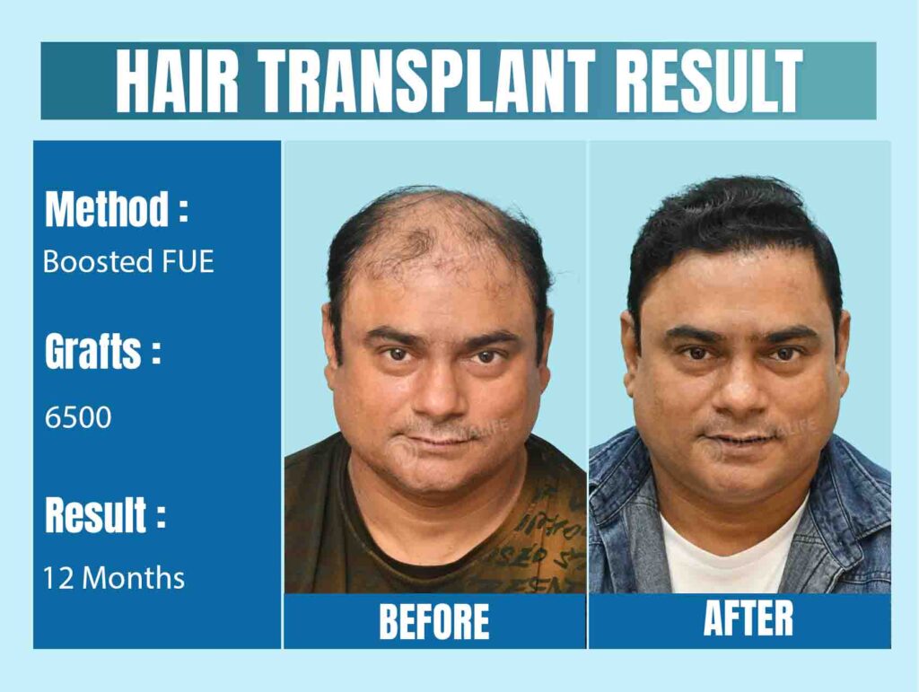 top celebrity hair transplant doctors in india