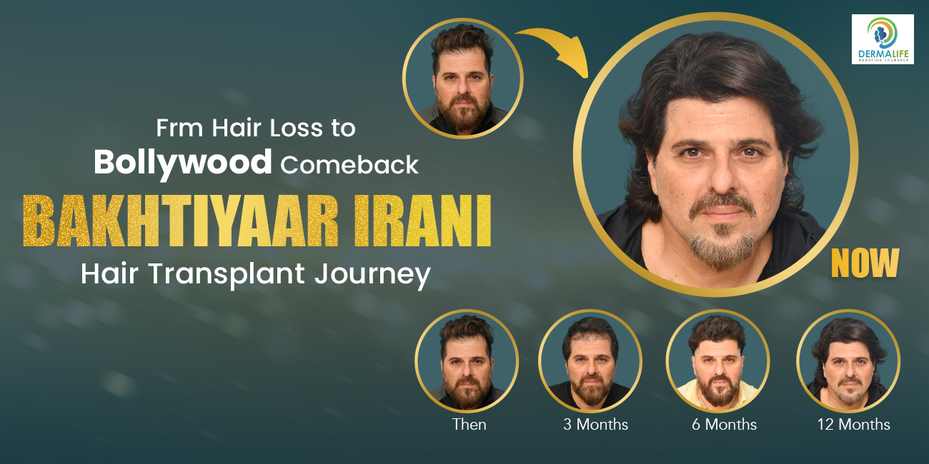 Bakhtiyar Irani's Hair Transplant Journey From Hair Loss to Bollywood Comeback
