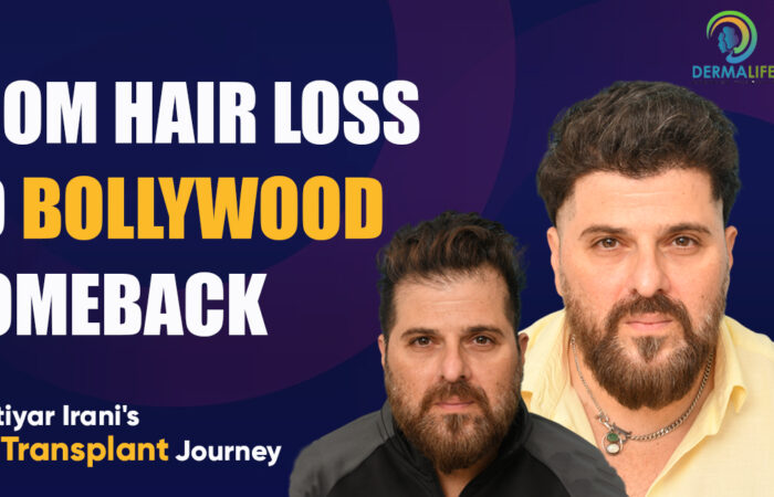 Bakhtiyar Irani's Hair Transplant Journey From Hair Loss to Bollywood Comeback