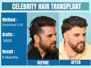 Celebrity Hair Transplant Before After Results